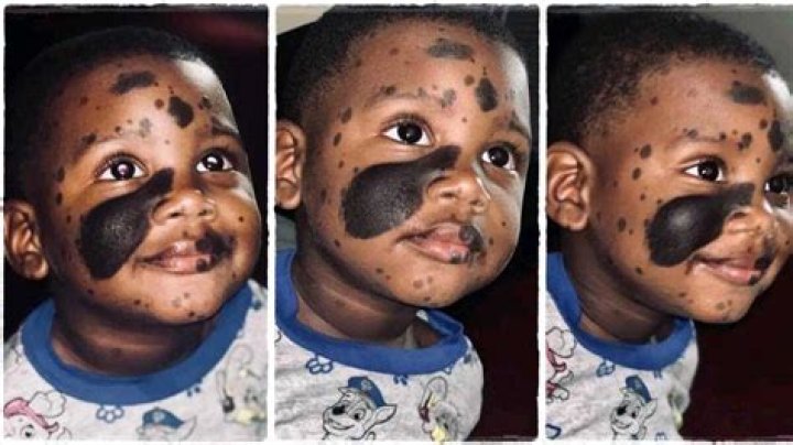 How To Support A Handsome Boy With Black Marks On His