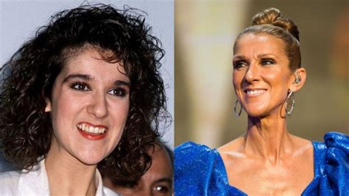 Has Celine Dion Undergone Rhinoplasty?