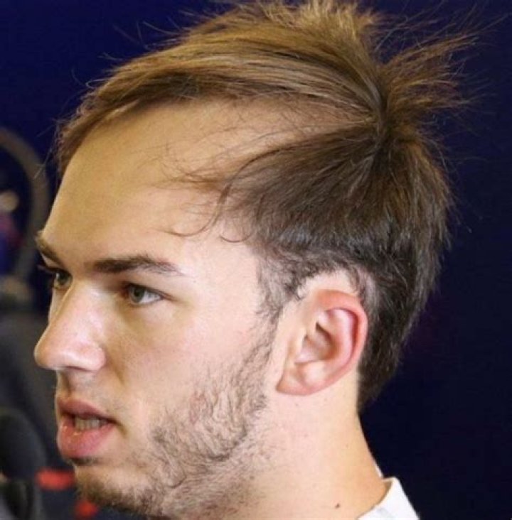 Unveiling Pierre Gasly's Hair Loss: Insights And Revelations