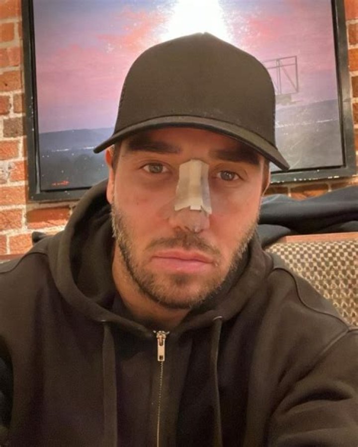 What Happened To James Lock S Face